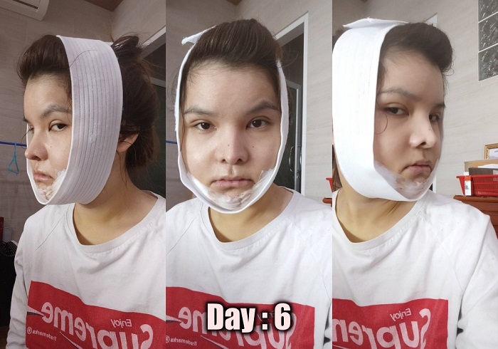 [รีวิวทำคาง+ตัดกราม+ทุบโหนก]ทุบทั้งหน้า!!ทำวีไลน์กับหมอไทยแก้คางสั้นกรามใหญ่โหนกแก้มสูง