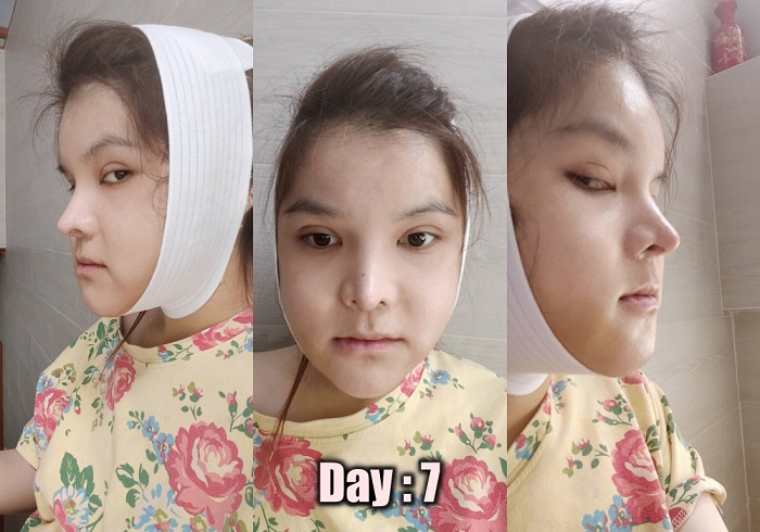 [รีวิวทำคาง+ตัดกราม+ทุบโหนก]ทุบทั้งหน้า!!ทำวีไลน์กับหมอไทยแก้คางสั้นกรามใหญ่โหนกแก้มสูง