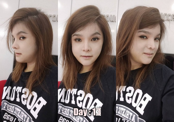[รีวิวทำคาง+ตัดกราม+ทุบโหนก]ทุบทั้งหน้า!