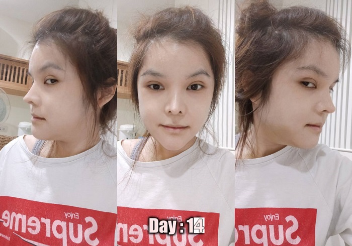 [รีวิวทำคาง+ตัดกราม+ทุบโหนก]ทุบทั้งหน้า!!ทำวีไลน์
