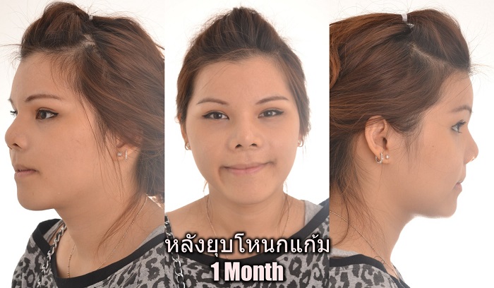 [รีวิวทำคาง+ตัดกราม+ทุบโหนก]ทุบทั้งหน้า!!