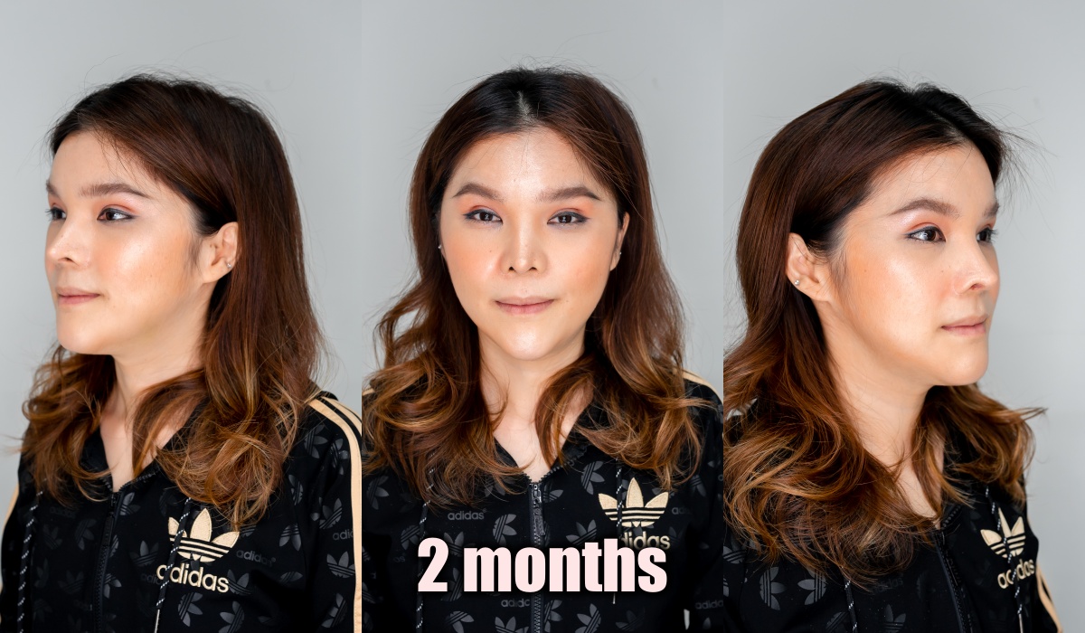 [รีวิวทำคาง+ตัดกราม+ทุบโหนก]ทุบทั้งหน้า!!แก้คางสั้นกรามใหญ่โหนกแก้มสูง