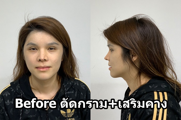 [รีวิวทำคาง+ตัดกราม+ทุบโหนก]ทุบทั้งหน้า!!