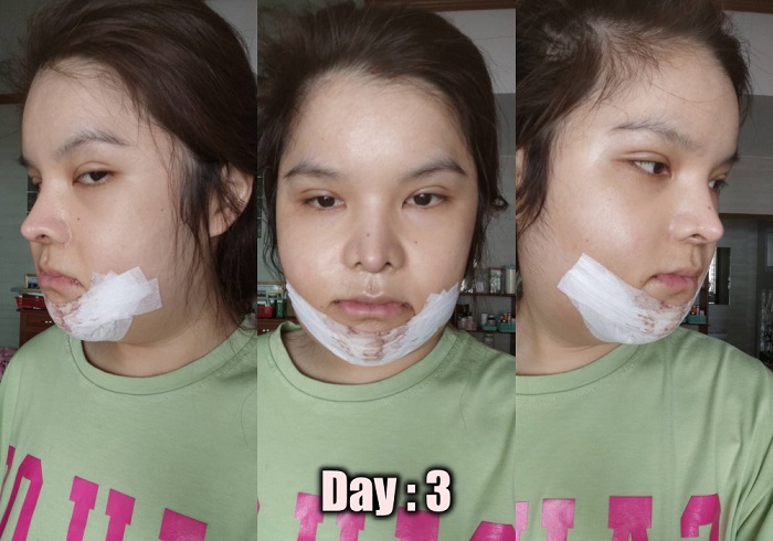 [รีวิวทำคาง+ตัดกราม+ทุบโหนก]ทุบทั้งหน้า!!ทำวีไลน์กับหมอไทยแก้คางสั้นกรามใหญ่โหนกแก้มสูง