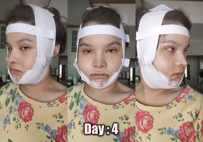 [รีวิวทำคาง+ตัดกราม+ทุบโหนก]ทุบทั้งหน้า!!ทำวีไลน์กับหมอไทยแก้คางสั้นกรามใหญ่โหนกแก้มสูง