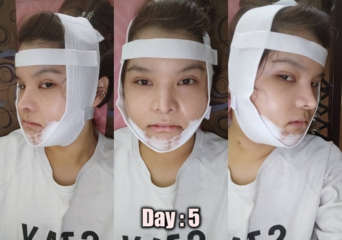 [รีวิวทำคาง+ตัดกราม+ทุบโหนก]ทุบทั้งหน้า!!ทำวีไลน์กับหมอไทยแก้คางสั้นกรามใหญ่โหนกแก้มสูง