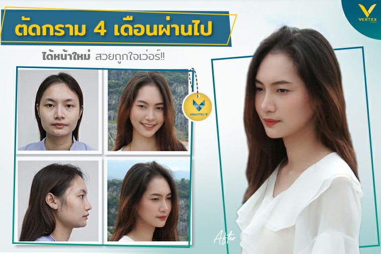 [รีวิวตัดกราม] อัปเดตรีวิวตัดกราม ครบ 4 เดือนที่ VertexClinic สวยปังถูกใจเวอร์!