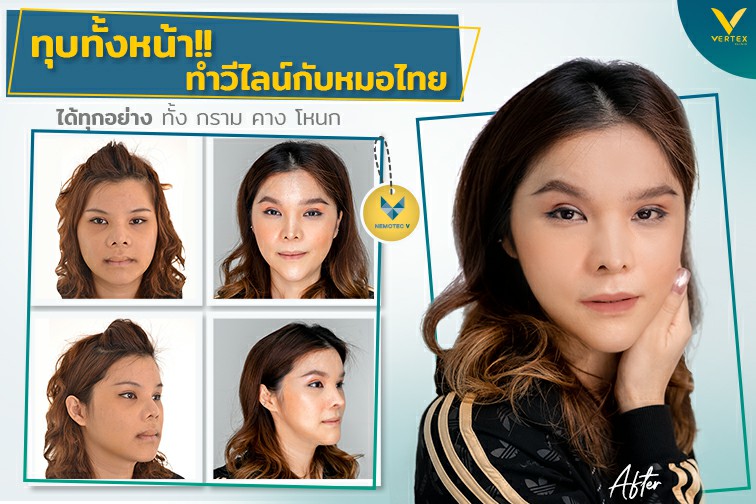 [รีวิวทำคาง+ตัดกราม+ทุบโหนก]ทุบทั้งหน้า!!ทำวีไลน์กับหมอไทยแก้คางสั้นกรามใหญ่โหนกแก้มสูง