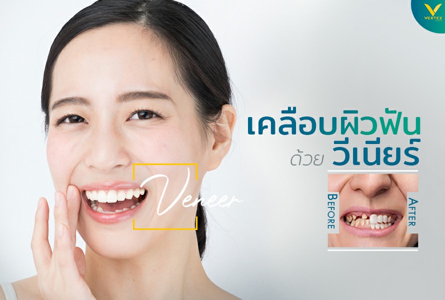 วีเนียร์ เคลือบฟันขาว แปะฟันขาว (Veneer)