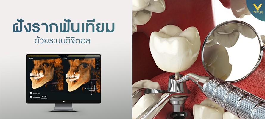 รากฟันเทียม