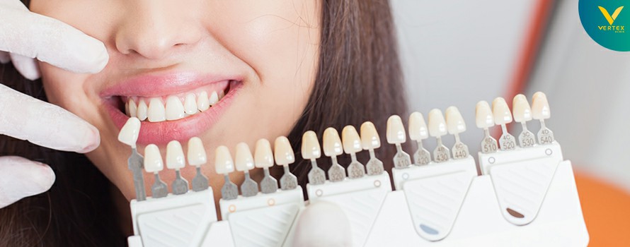 วีเนียร์ เคลือบฟันขาว แปะฟันขาว (Veneer)