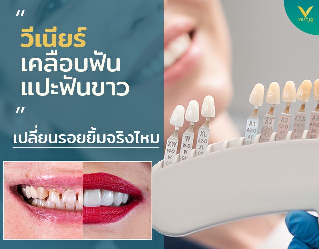 วีเนียร์ เคลือบฟันขาว แปะฟันขาว (Veneer)