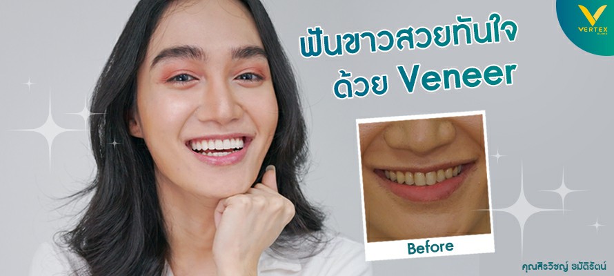 วีเนียร์ เคลือบฟันขาว แปะฟันขาว (Veneer)