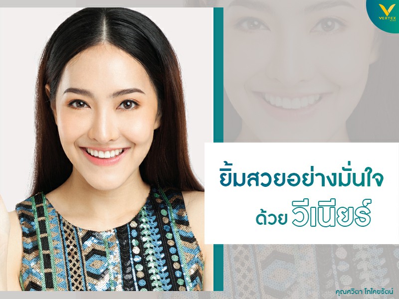 วีเนียร์ เคลือบฟันขาว แปะฟันขาว (Veneer)