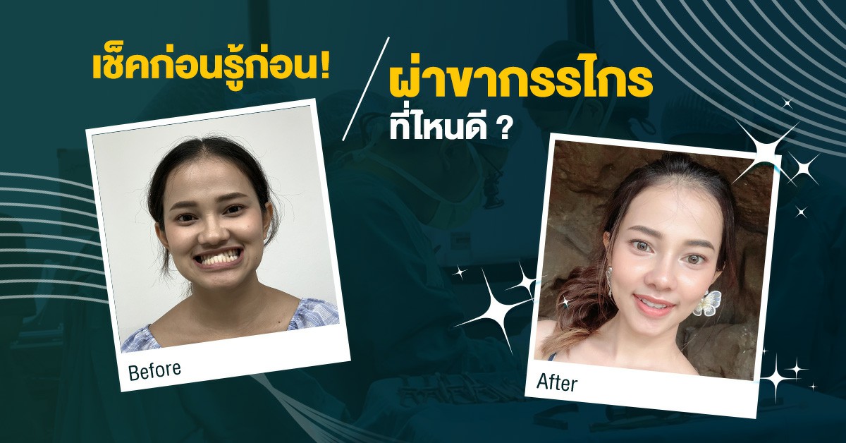 ผ่าขากรรไกรที่ไหนดี รักษาขากรรไกรที่ไหนดี แก้ฟันล่างคร่อมฟันบน