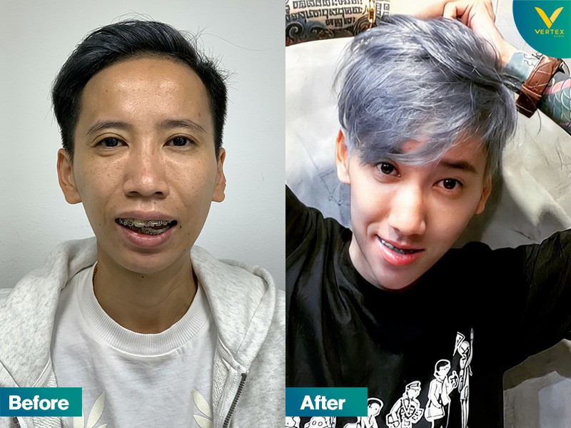 รีวิวผ่าขากรรไกร ผ่าตัดขากรรไกร แก้ ฟันล่างครอบฟันบน คางยื่น
