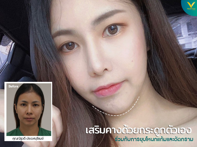 ศัลยกรรมคาง เสริมคาง