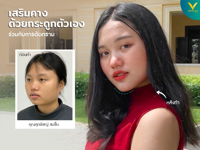 ทำคาง แก้คาง เสริมคางซิลิโคน เสริมคางด้วยกระดูกตัวเอง ทำคางที่ไหนดี ทำคาง แก้คาง เสริมคางซิลิโคน เสริมคางด้วยกระดูกตัวเอง ทำคางที่ไหนดี