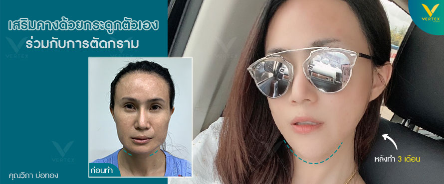 ศัลยกรรมคาง เสริมคาง ร่วมตัดกราม