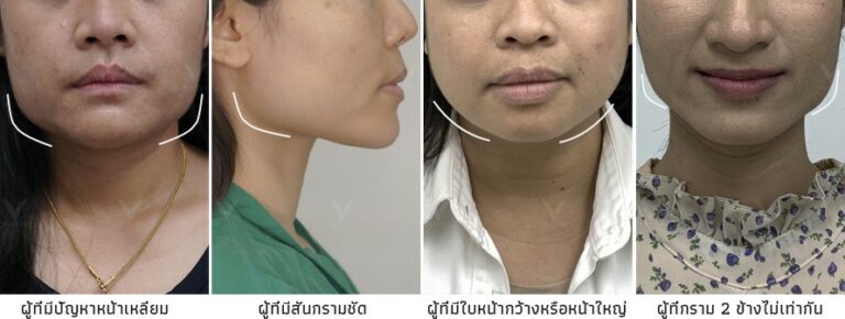 อยากตัดกราม เหลากราม แก้หน้าเหลี่ยม หน้าบาน