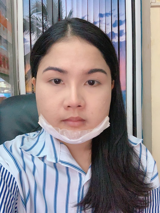 [รีวิวตัดกราม+ทำคาง+ตัดไขมันกระพุ้งแก้ม]