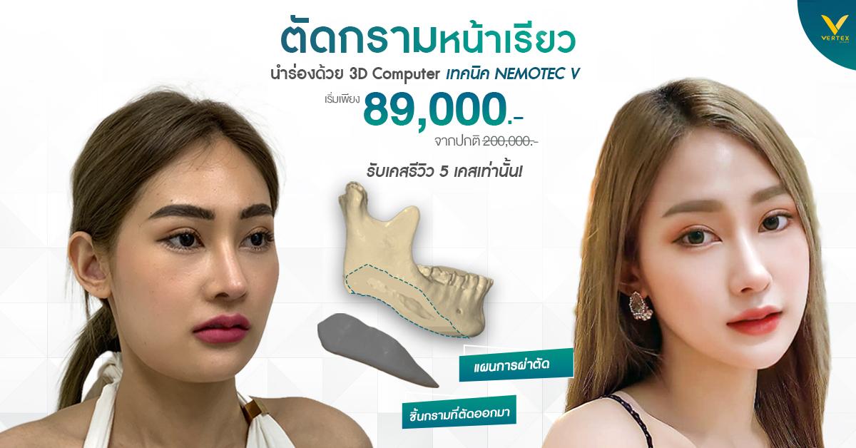 ตัดกรามราคาถูก ตัดกรามราคาเท่าไหร่ ต้องตัดกรามที่ไหนดี