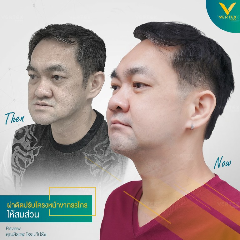 ฟันไม่สบกัน ผ่าตัดขากรรไกร แก้คางยื่น ขากรรไกรยื่น