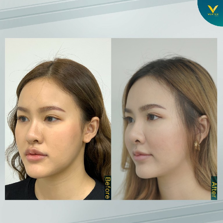 ฟันไม่สบกัน ผ่าตัดขากรรไกร แก้คางยื่น ขากรรไกรยื่น