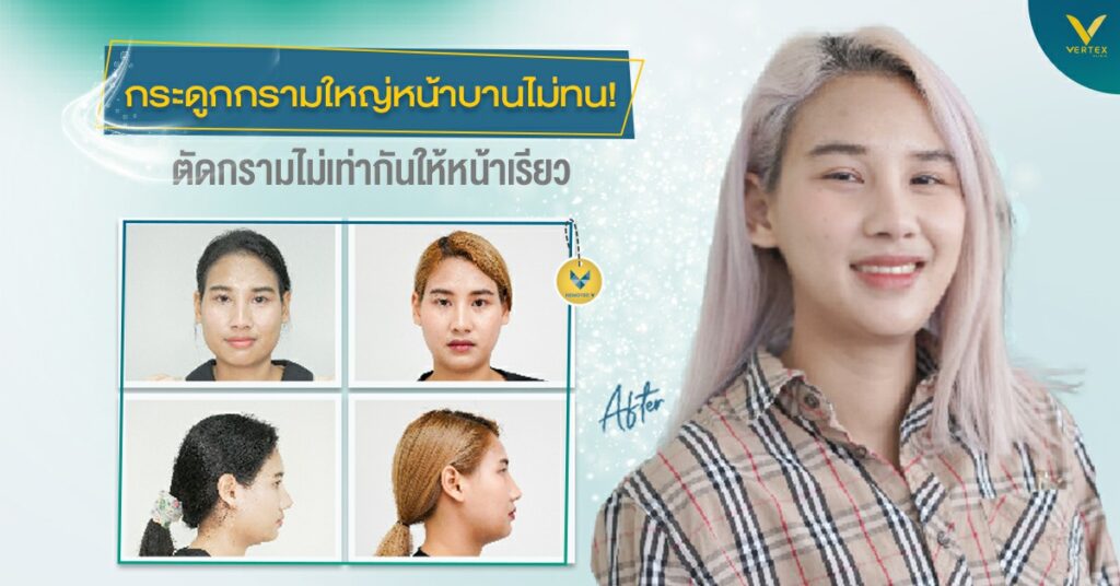 กระดูกกรามใหญ่หน้าบานไม่ทน! รีวิวตัดกราม ลดกรามด้วยเทคนิค Nemotec V
