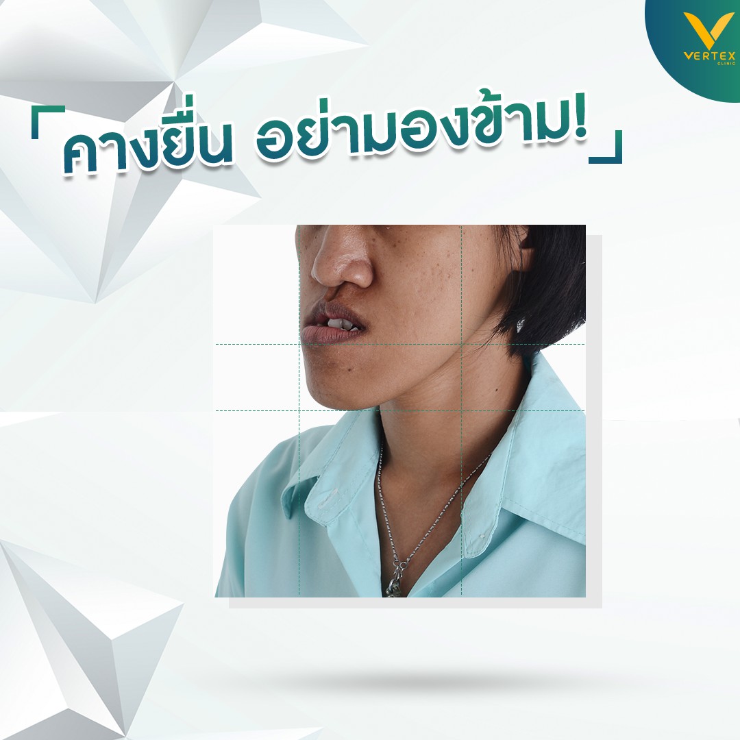 ปัญหาคางยื่น ใบหน้าไม่ได้รูป มีความผิดปกติ ไม่ควรมองข้าม ต้องได้รับการแก้ไข