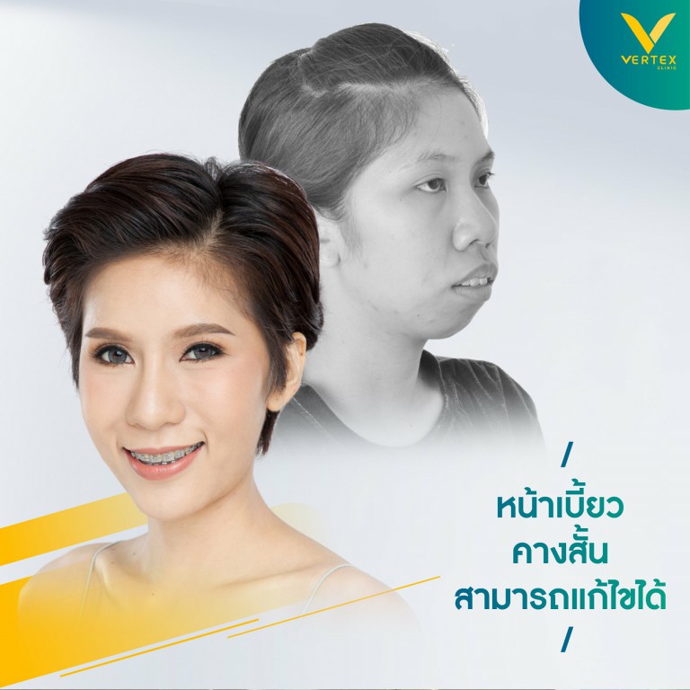 โครงหน้าพัง แก้ไขได้ ไม่ต้องบินไปไกลถึงเกาหลี