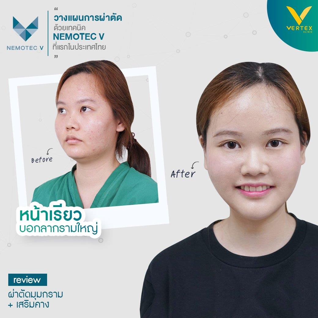 ปรับโครงหน้า ผ่าตัดมุมกราม และเสริมคาง โดยคุณพุธิตา