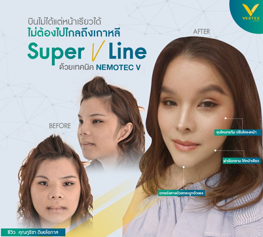 ปรับโครงหน้า ยุบโหนกแก้ม ผ่าตัดมุมกราม และเสริมคาง โดยคุณภูริชา