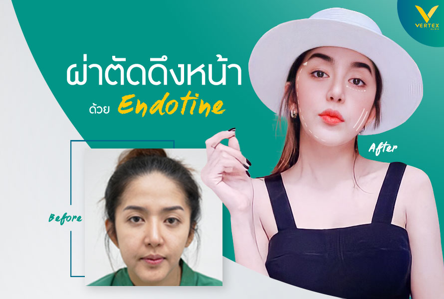 ดึงหน้า Endotine ยกกระชับหน้า ยกผิวหน้า หน้าเหี่ยว ผิวหน้าหย่อนคล้อย ดึงหน้า Endotine ยกกระชับหน้า ยกผิวหน้า หน้าเหี่ยว ผิวหน้าหย่อนคล้อย
