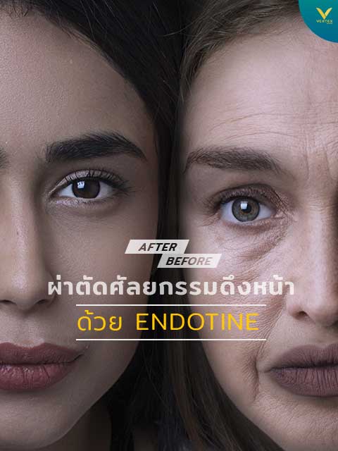 ดึงหน้า Endotine ยกกระชับหน้า ยกผิวหน้า หน้าเหี่ยว ผิวหน้าหย่อนคล้อย ดึงหน้า Endotine ยกกระชับหน้า ยกผิวหน้า หน้าเหี่ยว ผิวหน้าหย่อนคล้อย