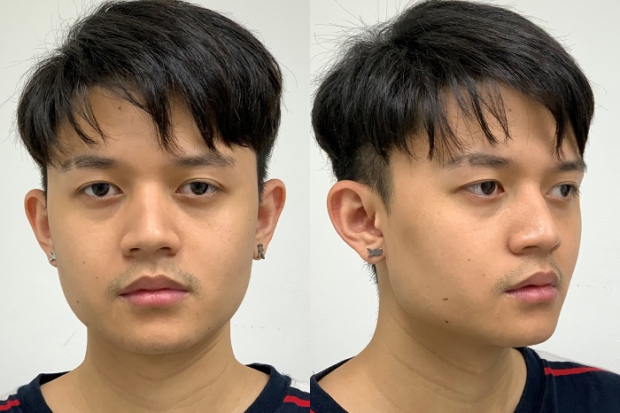 รีวิวตัดกราม กระดูกกราม ลดกรามถาวร ตัดกรามหน้าเรียว ผ่าตัดมุมกราม