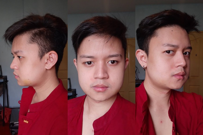 รีวิวผ่าตัดมุมกราม ตัดกรามหน้าเรียว ลดกรามถาวร กระดูกกราม ตัดกราม