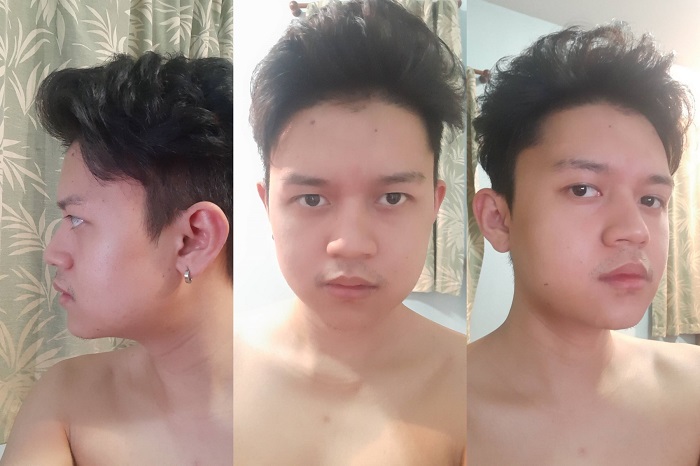 ผ่าตัดมุมกราม รีวิว ตัดกรามหน้าเรียว ลดกรามถาวร กระดูกกราม ตัดกราม