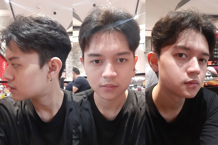 รีวิวศัลยกรรมมุมกราม ตัดกรามหน้าเรียว ลดกรามถาวร กระดูกกราม ตัดกราม