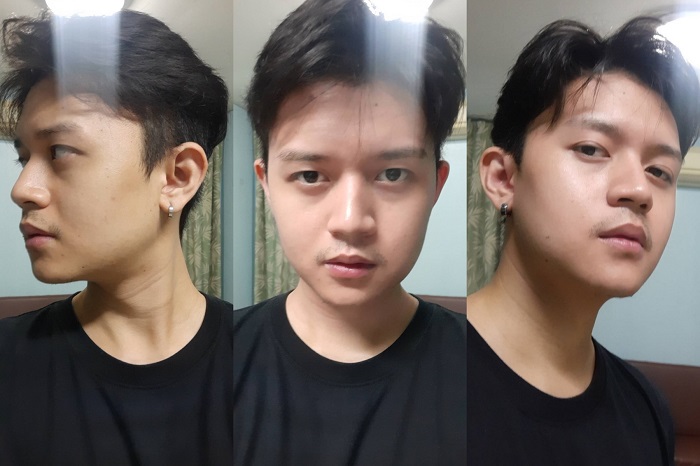 ศัลยกรรมมุมกราม ตัดกรามหน้าเรียว ลดกรามถาวร รีวิวกระดูกกราม ตัดกราม
