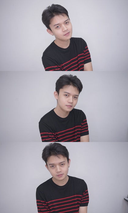 ผ่ากราม ตัดกรามหน้าเรียว รีวิวลดกรามถาวร กระดูกกราม ตัดกราม