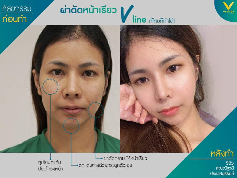 รีวิวผ่าตัดหน้าเรียววีไลน์ 3 จุด จากคนไข้จริง คุณณัฐวดี