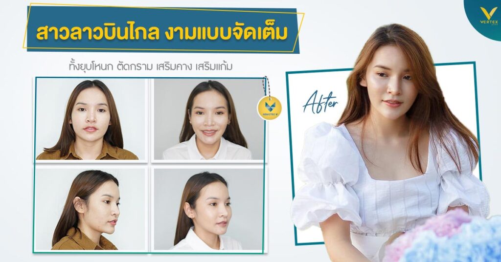 รีวิวยุบโหนกตัดกราม เสริมแก้มตอบ เสริมคาง แก้กรามใหญ่โหนกแก้มสูง