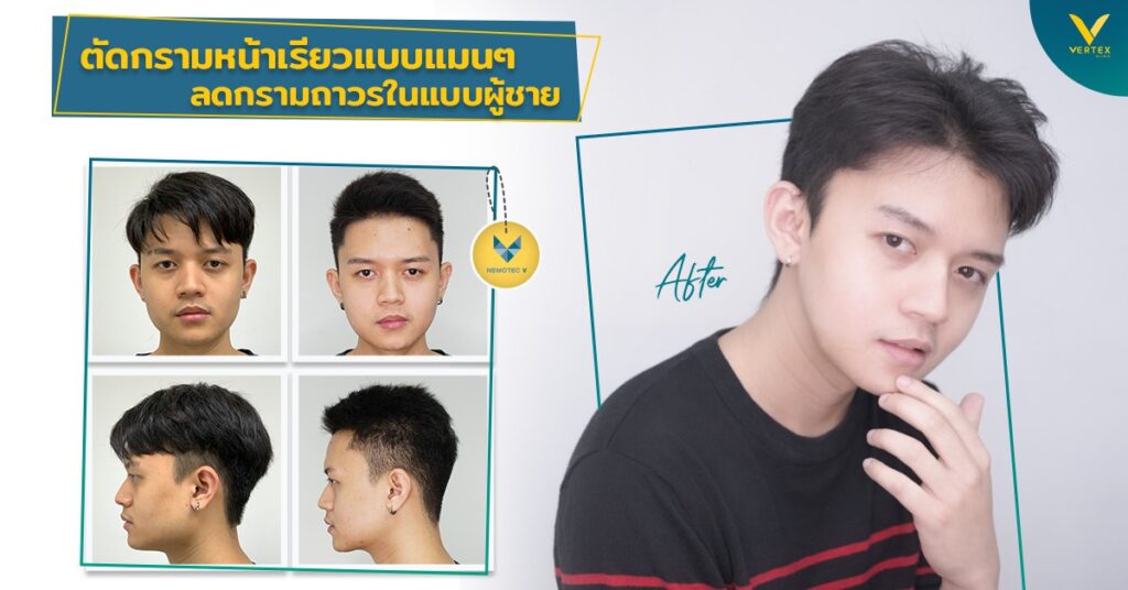 [รีวิวตัดกราม] ตัดกรามหน้าเรียวแบบแมนๆ ลดกรามถาวรในแบบผู้ชาย