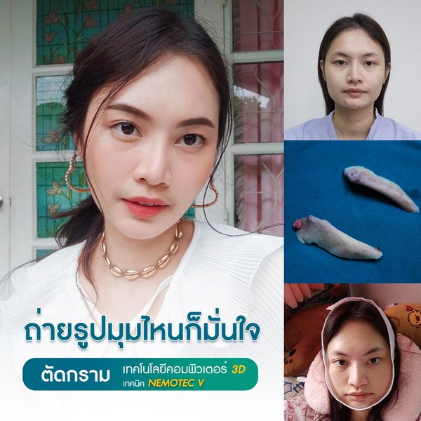 ตัดกราม เหลากราม ศัลยกรรมกราม ด้วย เทคนิค Nemotec V