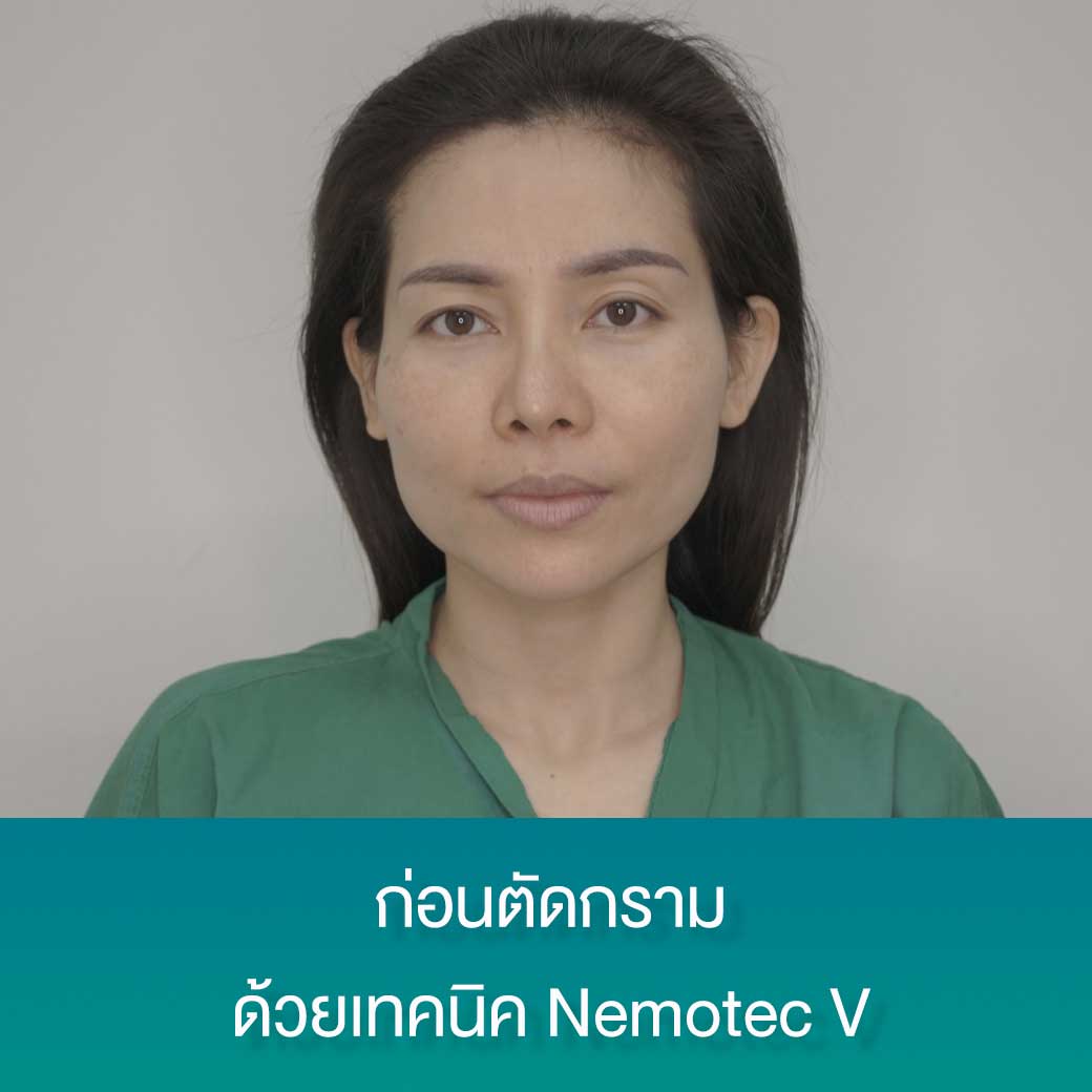 angle-reduction-nemotec-v