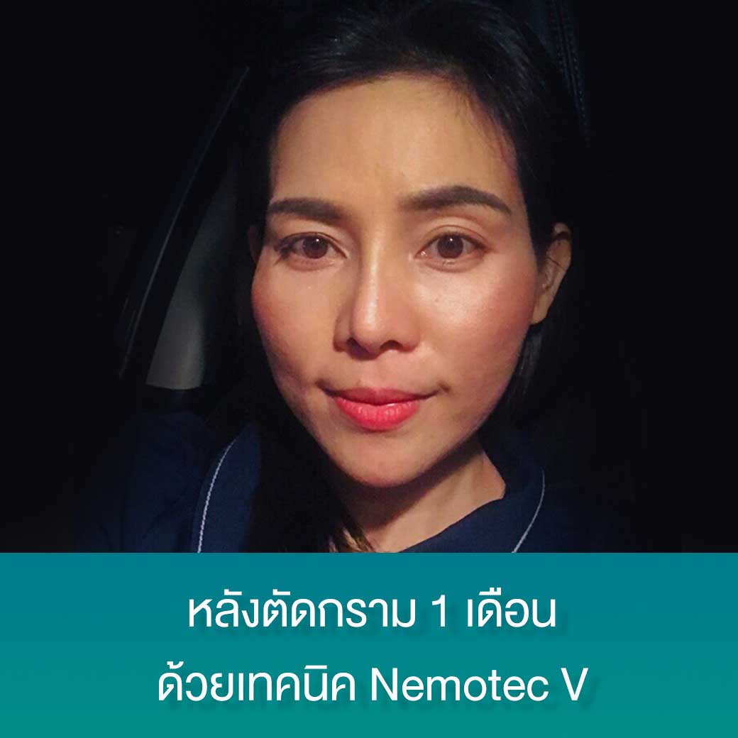 angle-reduction-nemotec-v