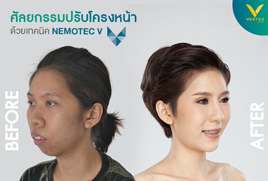 ปรับโครงหน้า