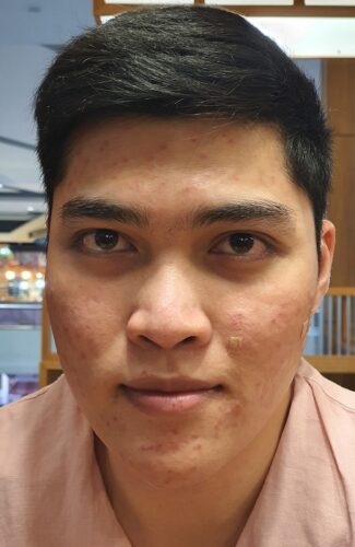 รีวิวผ่าตัดขากรรไกร ผ่าขากรรไกร ผ่าตัดขากรรไกรรีวิว ผ่าตัดขากรรไกรราคา ผ่าตัดขากรรไกร ผ่าขากรรไกร ผ่าตัดขากรรไกรรีวิว ผ่าตัดขากรรไกรราคา