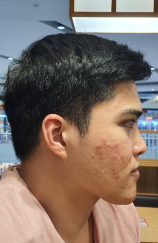 ผ่าตัดขากรรไกร Review ผ่าขากรรไกร ผ่าตัดขากรรไกรรีวิว ผ่าตัดขากรรไกรราคา Review ผ่าตัดขากรรไกร ผ่าขากรรไกร ผ่าตัดขากรรไกรรีวิว ผ่าตัดขากรรไกรราคา